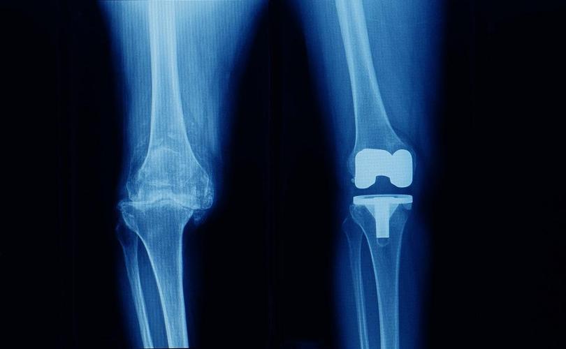 Everything You Need to Know Before Getting a Knee Arthroplasty